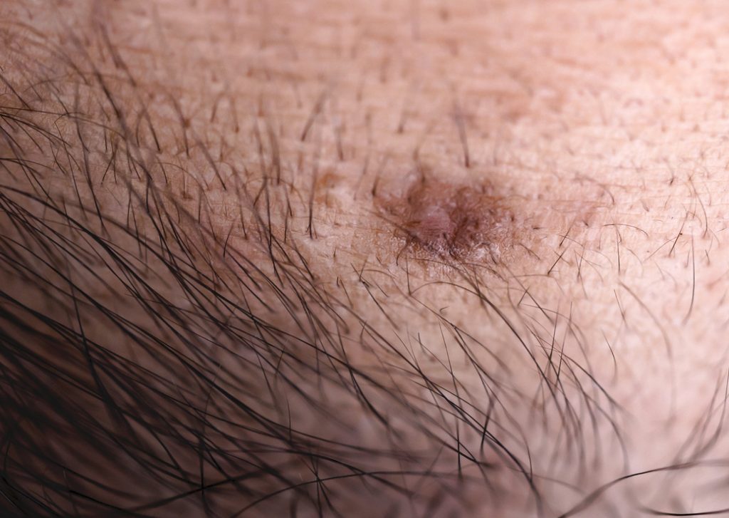 Sind Leberflecken u.ä. im Intimbereich abschreckend?